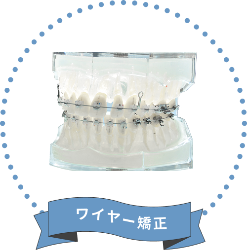 ワイヤー矯正